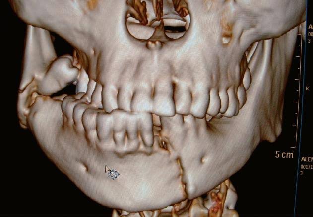accidental-fracture Accidental Fracture
