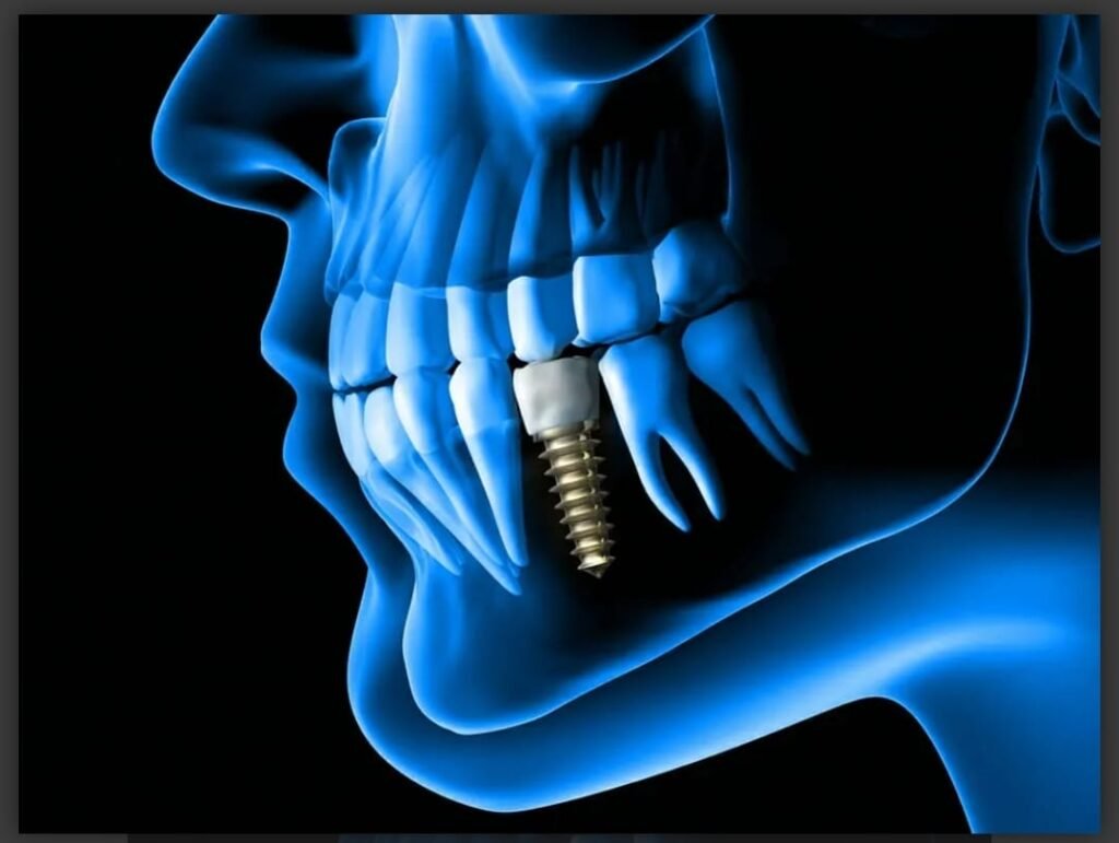 dental implant 1024x771 dental implant 1024x771